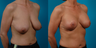 Breast lift and implants