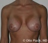 Mastopexy