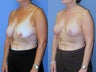 Vertical mastopexy