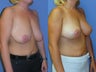 Vertical breast lift