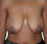 Breast Lift