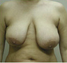 Breast Lift