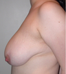 Vertical Breast Lift