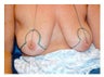 Breast Lift