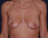 scarless breast lift