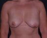 breast lift
