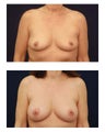 Breast Lift