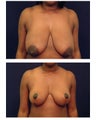 Breast Reduction & Lift