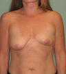Breast Augmentation/Lift