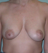 Breast Augmentation/Mastopexy (Lift)