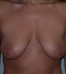 Breast Augmentation / Lift