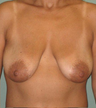 Breast Augmentation / Lift