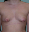 Breast Augmentation / Lift