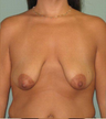 Breast Augmentation / Lift