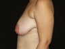 Mastopexy