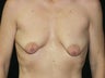 Mastopexy and Breast Implants