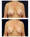Breast Lift