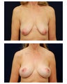 Breast Lift