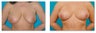 Breast Lift/Mastopexy