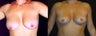 Breast Lift/Mastopexy