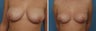 Breast Lift/Mastopexy