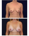Breast Augmentation with Lift