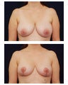 Breast Lift