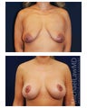 Breast Augmentation with Lift
