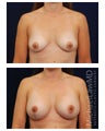 Breast Augmentation with Lift