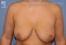Breast Lift & Augmentation