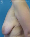 Breast Lift & Augmentation