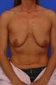 Mastopexy w/ Breast Augmentation