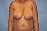 Breast Lift