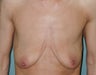 Breast Lift
