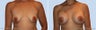 Breast Augmentation