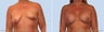 breast lift