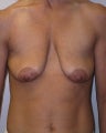 Breast Lift