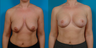 Breast lift and implants