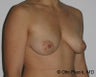 Mastopexy