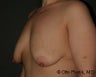 Mastopexy