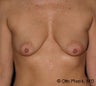 Mastopexy