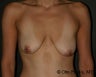 Mastopexy