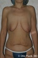 Mastopexy