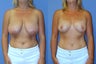 Vertical Mastopexy