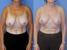 Vertical mastopexy