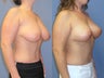 Vertical breast lift