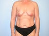 Breast Lift