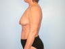 Breast Lift