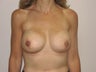 Bilateral Breast Reconstruction with Implants and Allograft
