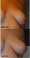 LSGAP "Love Handle" Flap Breast Reconstruction